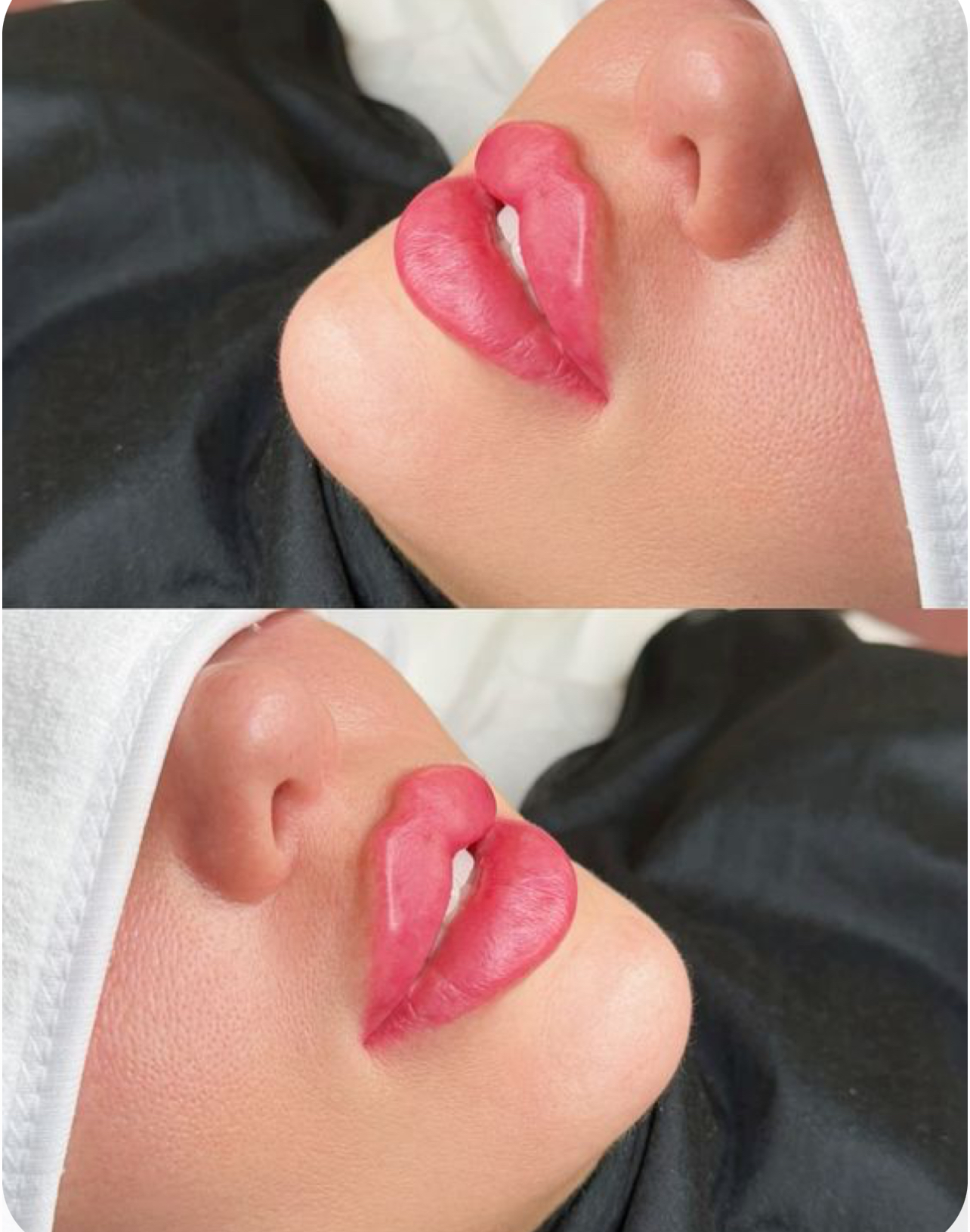 فلر الشفه ابرة واحده