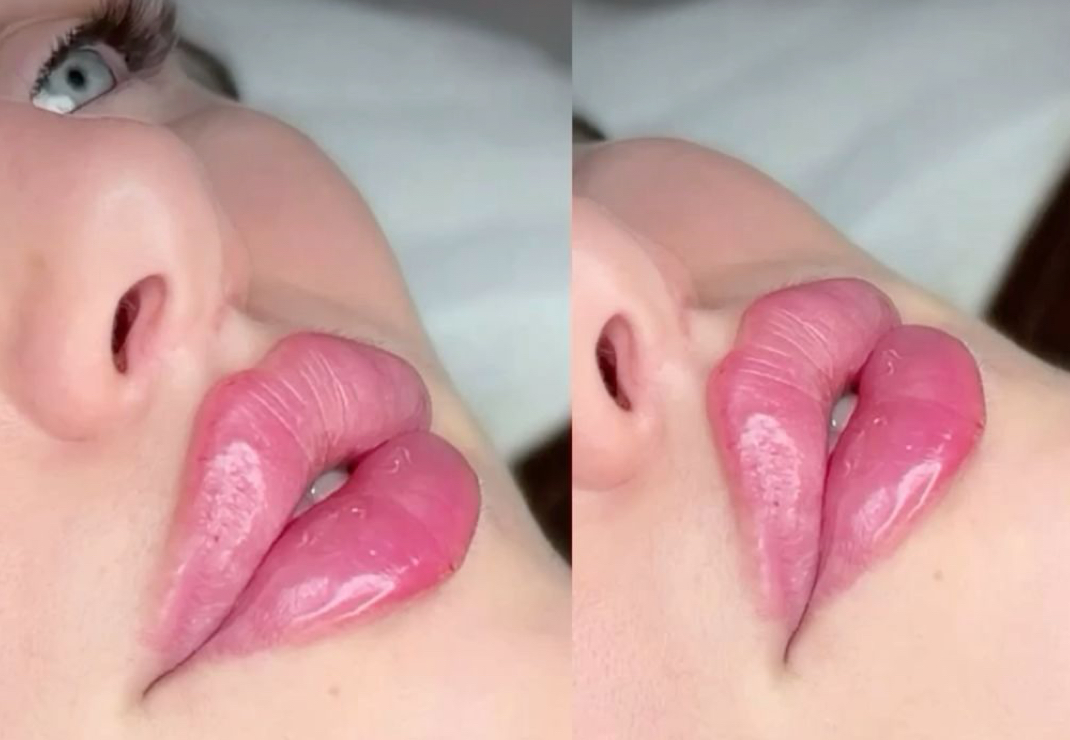 ابرتين فلر الشفايف