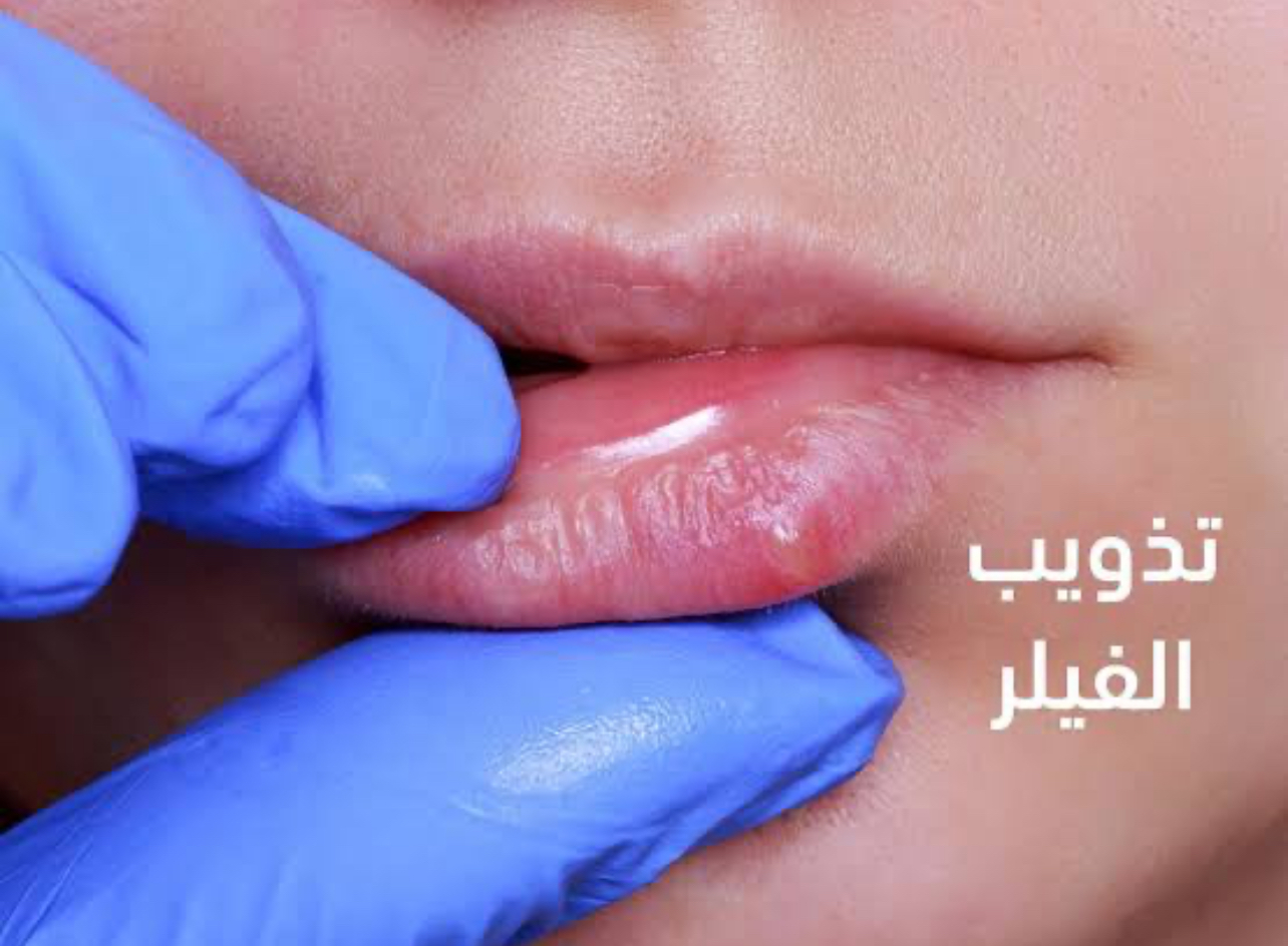 ابرة تذويب الفلر