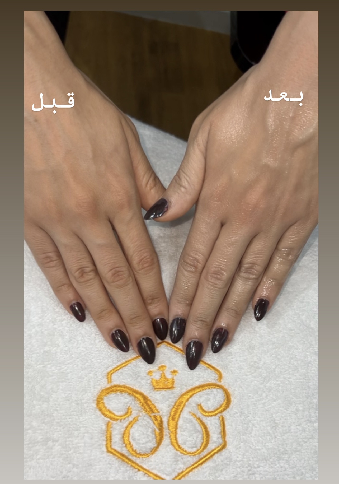 تقشير ليزر كاربوني لليدين