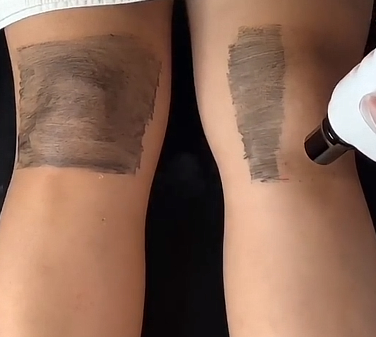 تقشير ليزر كاربوني للركب