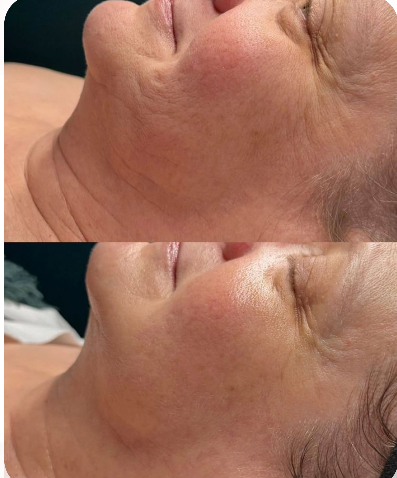 جلسة السمارت فيس ليفت ( هايفو مع فايبريشن ) وجه + رقبة + لغد